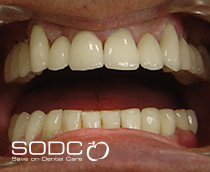 Dental implants