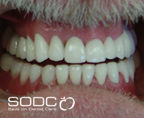 Dental implants