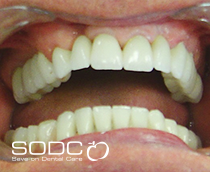 Dental implants