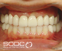 Dental implants