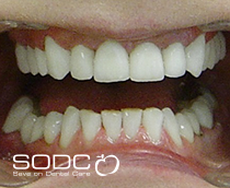 Dental implants, porcelain crowns
