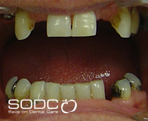 Dental implants
