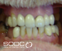 Dental implants