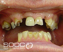 Dental implants