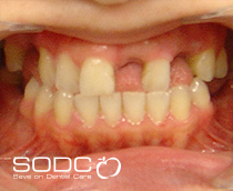 Dental implants