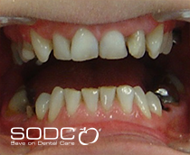 Dental implants, porcelain crowns