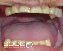 Dental Implants