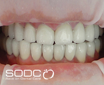 Dental implants, porcelain bridges
