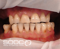 Dental implants, porcelain bridges