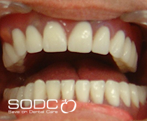 Implant retained denture