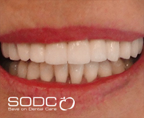 Fixed denture with implants