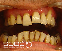 Implant retained denture