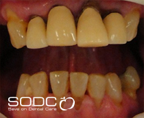 Fixed denture with implants