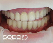 Dental implants, porcelain crowns, veneers