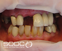 Dental implants, porcelain crowns, veneers