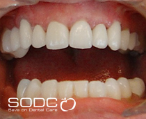 Porcelain crowns