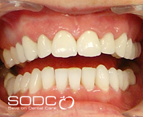 Tooth coloured filling and Opalescence tooth whitening