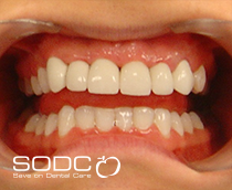 Pressed ceramic E-max veneer