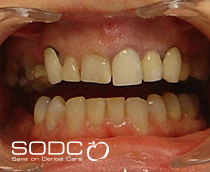 Porcelain crowns