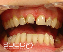 Tooth coloured filling and Opalescence tooth whitening