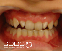 Pressed ceramic E-max veneer