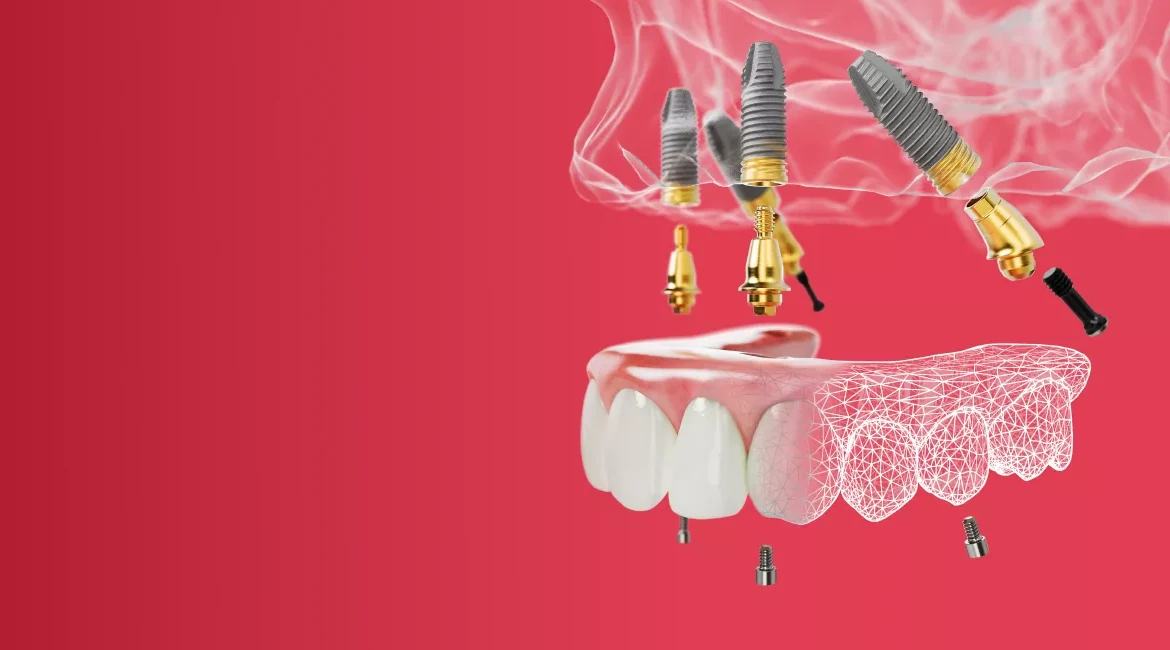 Full-Mouth Dental Implants